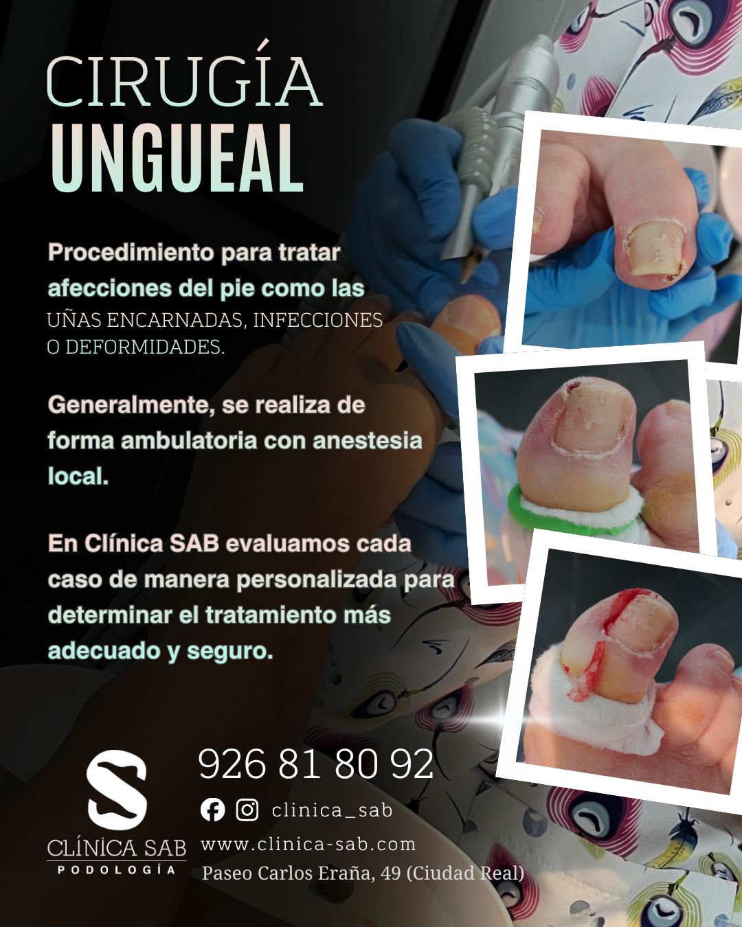 Cirugía para uñas encarnadas